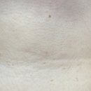 라온메디 | [내돈내산] 메디라온 연고(쥐젖 연고) 한 통(약 60일) 사용 후기 / 효과가 없는 것은 아닌데... (사진주의)