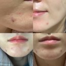 큰나무약국 | 피부트러블 붉은기없애는법 약국리페어크림 세라바인 타마누 크림 2주 후기