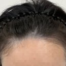 m헤어 | 원주 두피SMP 후기｜M자 헤어라인 자연스럽게 보완한 위드나인