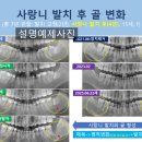 함께웃는치과교정과치과의원 | 사랑니 뺀 자리의 뼈가 어떻게 되는지 궁금하다면 보여드립니다. - 웃는E치과교정과치과의원