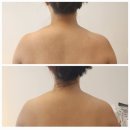 부산 하이퍼소닉 승모근 거북목 관리 주블룸스킨랩