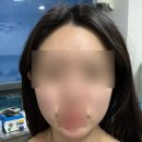 케이톡스의원 | 내돈내산케이톡스 마곡 울쎄라 400샷 후기 +생각보다 많이부어요