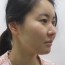 유로성형외과，피부과 | 위드유성형외과, 광명피부과에서 이마지방이식 실리프팅 받은 후기!