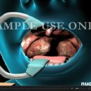 3D Medical Animation Tonsillectomy Surgery 이미지