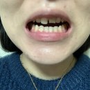 광주치과추천 깨지고 벌어진 앞니 앞니크라운 연제현치과 내돈내산 솔직후기