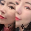 타임메디텍 | 차메디텍 리바이브PCL 신사피부과에서 받은 모공스킨부스터 찐 후기