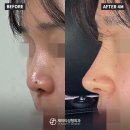 예뻐지는의원 | 🍀[코성형 전후 셀카] 자연스럽게 예뻐지는 코성형 후기