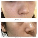 페츠업 동물병원 | 루비레이저 내돈내산 일주일~ 한달 후 상세한 후기, 부작용, 토닝 루비레이저 차이