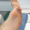 푸스러블 | 문제성 발 1:1 케어관리 문제성발톱, 내성발톱, 발톱무좀관리 푸스러블에서 발 각질관리받은 솔직후기!