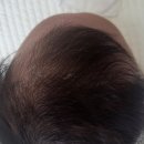 아워홈아주대학교병원장례식장점 | 치료 3탄_두상교정헬멧 5개월 착용 후 졸업 후기ㅣ이노야드 두상 교정센터 수원점 장점 & 단점 솔직 후기