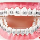 피엘의원 | 성인 치아교정기 종류와 비용은? 늦은 시기는 아닐까