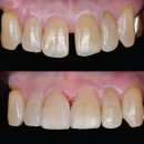 청주이튼치과기공소 | [청주치과] 벌어진 앞니, 당일에 깎지 않고 완성하는 디테일의 차이 (레진 빌드업)