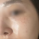 아우름의원 | [서울 피부과] 주근깨 오타양모반 잡티 제거 치료 내돈내산 후기 “아우름의원”