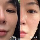 강남성형외과 | 쥬베룩스킨부스터4cc 후기 | 효과 | 통증
