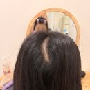 TMW 탈모왕수원 | [내 경험담] 여자 원형탈모 원인, 치료 &amp; 후기