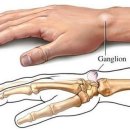 손목에 혹? 결절종을 의심해봐야 이미지