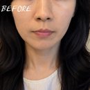 YS고압 나4 | 청담동피부과 줄기세포 시술 내돈내산후기 물광주사·고압산소치료까지 받은 안티에이징 관리