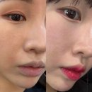 365자연안에건강 | 청담피부과 올리디아 365 스킨부스터 콜라겐주사 시술 효과 통증 후기