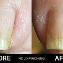 홀드핀칭 이미지