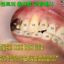 ◆ 치과의사가 밝히는 임플란트의 비밀 1편 교합 이미지