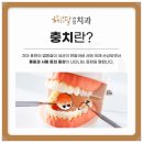 경대연합치과의원 | 경대병원치과 자연치아를 최대한 보존하는 치료 원하신다면