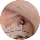 서울닥터김치과의원 | 위례 부분교정 후기 | "40대에도 교정 가능할까요?" 8개월만에 달라진 사례, 이아소치과