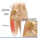 Re:Re: meralgia paresthetica 이미지