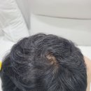 소소우아 | 남편 두피 고민! 매일 사용하는 탈모샴푸 '소소우아 트리노바 퓨어' 4주 사용 후기