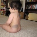 몽고반점 이미지