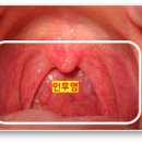 인후염 증상 원인 전염 인후염에 좋은 음식 이미지