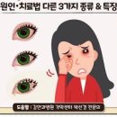 눈 결막염 초기증상 눈충혈 따가움 원인 이미지