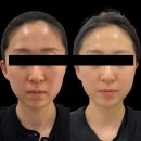 리뉴메디칼 대구지사 | ​대구 리프팅 성지 후기ㅣ티리온X 리프팅 추천ㅣ심부볼 팔자주름 눈밑 꺼짐 비대칭 이중턱 해결ㅣ아미...