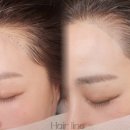 류헤어라인 이미지