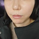 올리고365 | [미용] 내돈내산 송도피부과 | 콜라겐 스킨부스터 올리디아365 리뷰