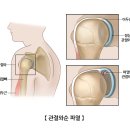 견비통 (어깨의 통증) 이미지