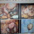 다빈치 미용실 | 동탄제일병원 다빈치 로봇 자궁근종수술 이인호 원장님 후기 -3 (퇴원 후 회복)