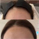 에이스헤어 (샵) | [일산 왁싱] ‘에이스왁싱’ 헤어라인 왁싱 후기