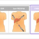 담석증 증상 원인 치료 쓸개담석 제거수술 해야만할까 이미지