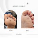 신항장외과의원 | 결과, 2주간의 기록과 최종 진단. 진주 하얀메디컬의원, 유아 흑색종 의심 제거수술 조직검사 받은 후기2