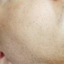 논현2-118 | 신논현여드름관리 로터스에스떼 남자 피부관리 처음 받아본 후기