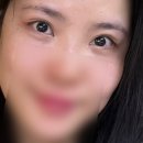 [내돈내산]•눈밑지 여우눈 언제쯤 돌아 올까유? 성형외과 눈밑지 1-4달 경과 후기! 무려 4000명이 읽음..