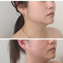 다사 동화아이위시 삼거리 | 다사 피부관리 라피움에스테틱 수기 윤곽 리프팅 대박