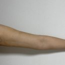 작은팔 | 팔 지방흡입 2주만에 변화 리얼 후기 지방흡입잘하는곳