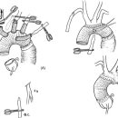 Axillary cerebral perfusion for arch surgery in acute type A dissection under moderate hypothermia 이미지