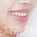 인비스치과의원 | 마산치아교정, 앞니 부분교정 치료케이스 후기