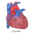 급성 심근경색증(Acute myocardial infarction) 이미지