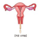 자궁내막암 (Endometrial Cancer) 이미지