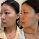 신에너지 | [공덕 올타이트리프팅 솔직후기] 시술 효과 전후 효과 비교 (서울피부과,전후사진,통증,비용)