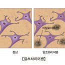 알츠하이머/ALZHEIMER 이미지