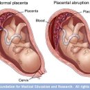 물리치료(PT) 자료 : Placental abruption 이미지